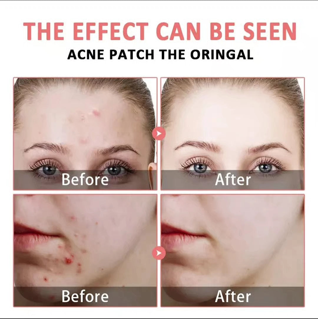 RapidClea Hydrocolloid Pimple Patches
